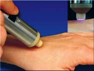 Plasmabehandlung von Haut